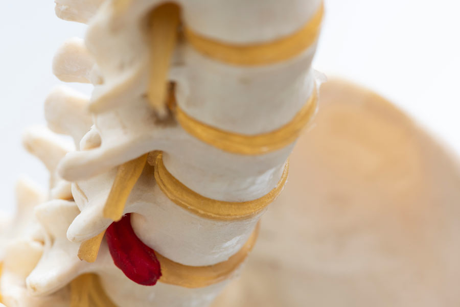 Spine Surgeon Research Focus: Cervical Disc Replacement and Patient Experiences